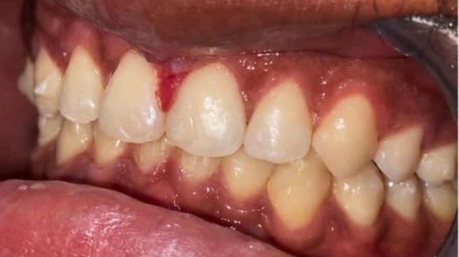 Teeth after treatment, evenly aligned with the gap closed