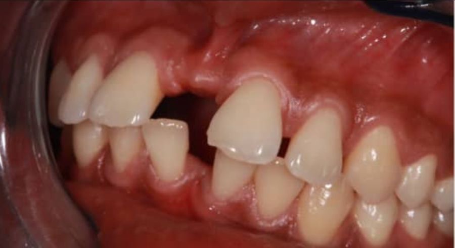 Teeth before treatment, with a gap and uneven spacing
